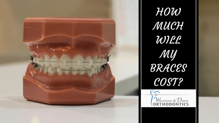 How Much Do Braces Cost?, Braces Price