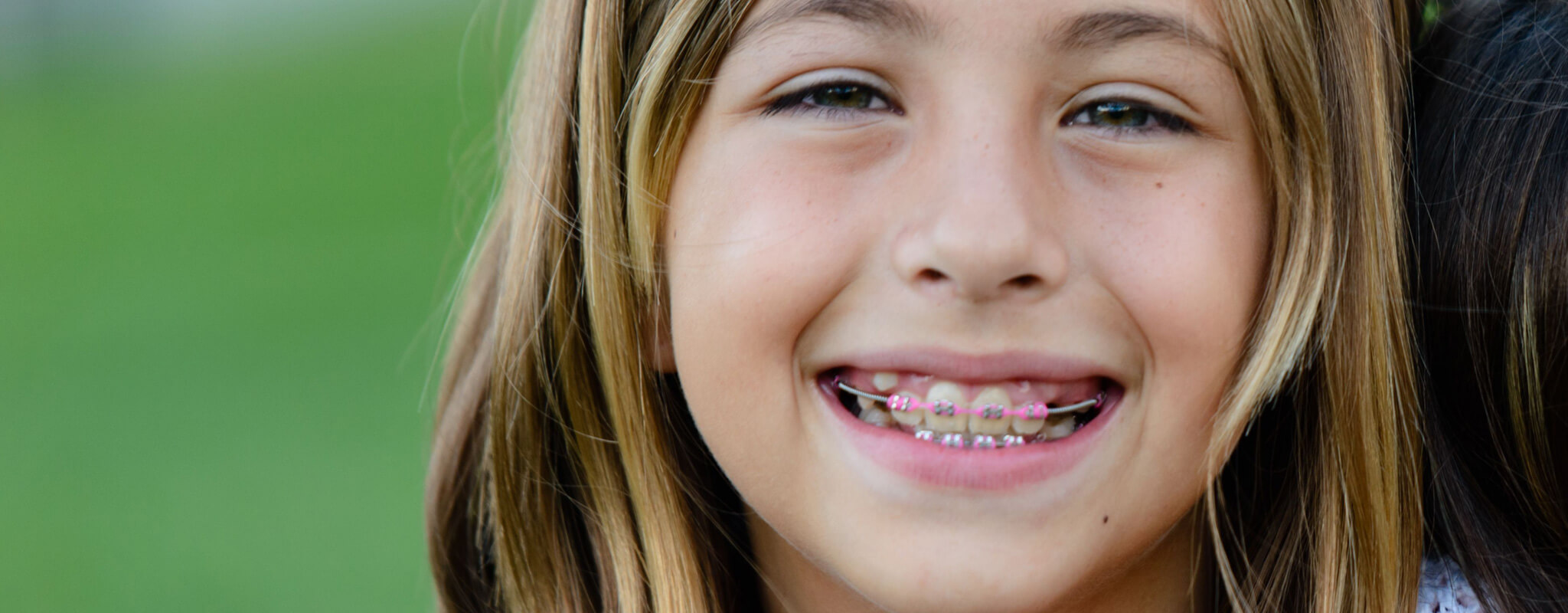 Can You Get Braces If You Have Missing Teeth Wiewiora Dunn 